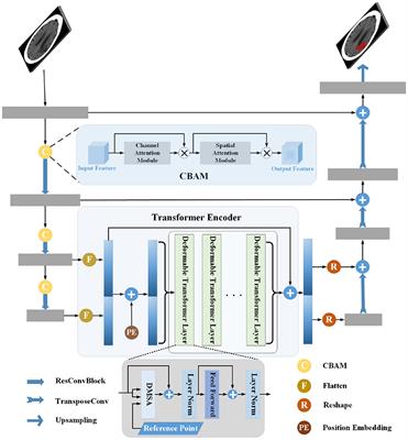 Combining convolutional attention mechanism and residual deformable Transformer for infarct segmentation from CT scans of acute ischemic stroke patients